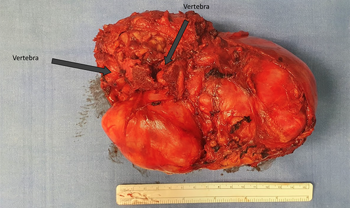 Giant Shwannoma invading the spine and the chest wall